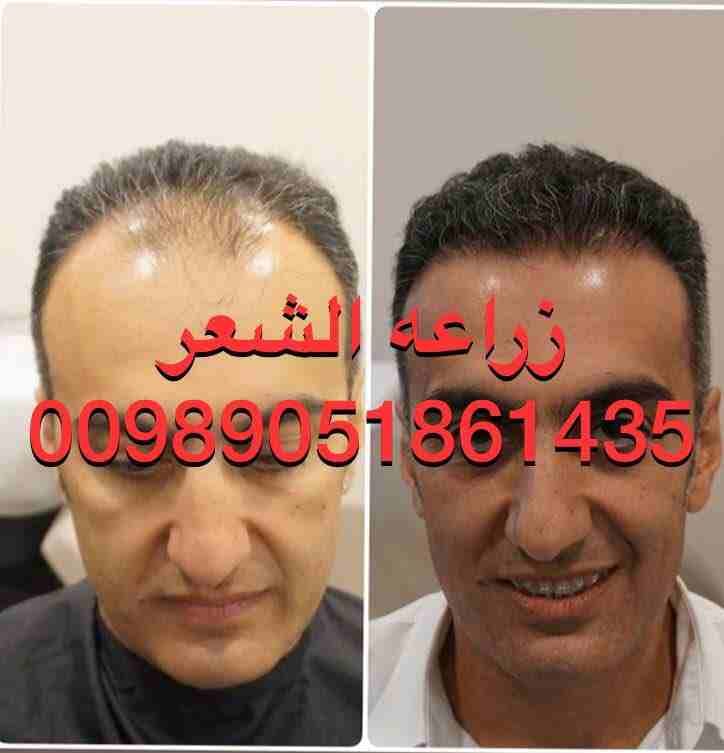 زراعه الشعر في ايران اهواز
أقصي درجه كثافه للشعر
نقل من الحدود، السكن ، تحاليل العمليه ،
بل اشراف طبيب جلدي و شعر
اتصال علي واتساپ
دكتوره سميه 00981861435